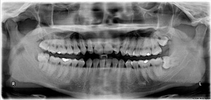 XRAY of teeth