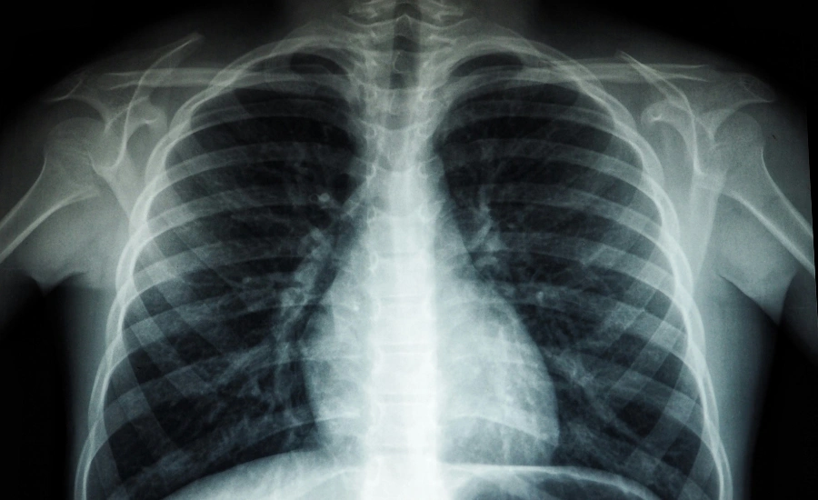 Chest xray