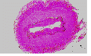 Cross section of an artery with intimal thickening